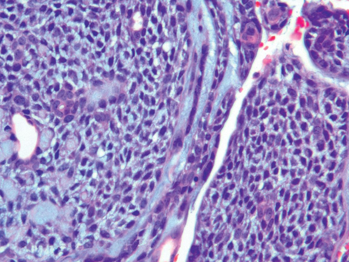 Figure 13.35, Area of solid growth in adenoid cystic carcinoma, with rare ductal cells and a predominance of myoepithelial cells (400× H&E stain).