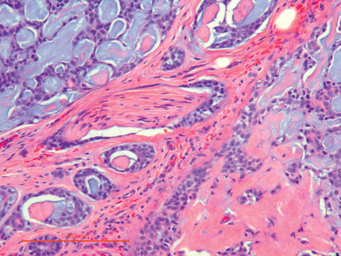 Figure 13.36, Perineural invasion is present centrally within this adenoid cystic carcinoma (400× H&E stain).