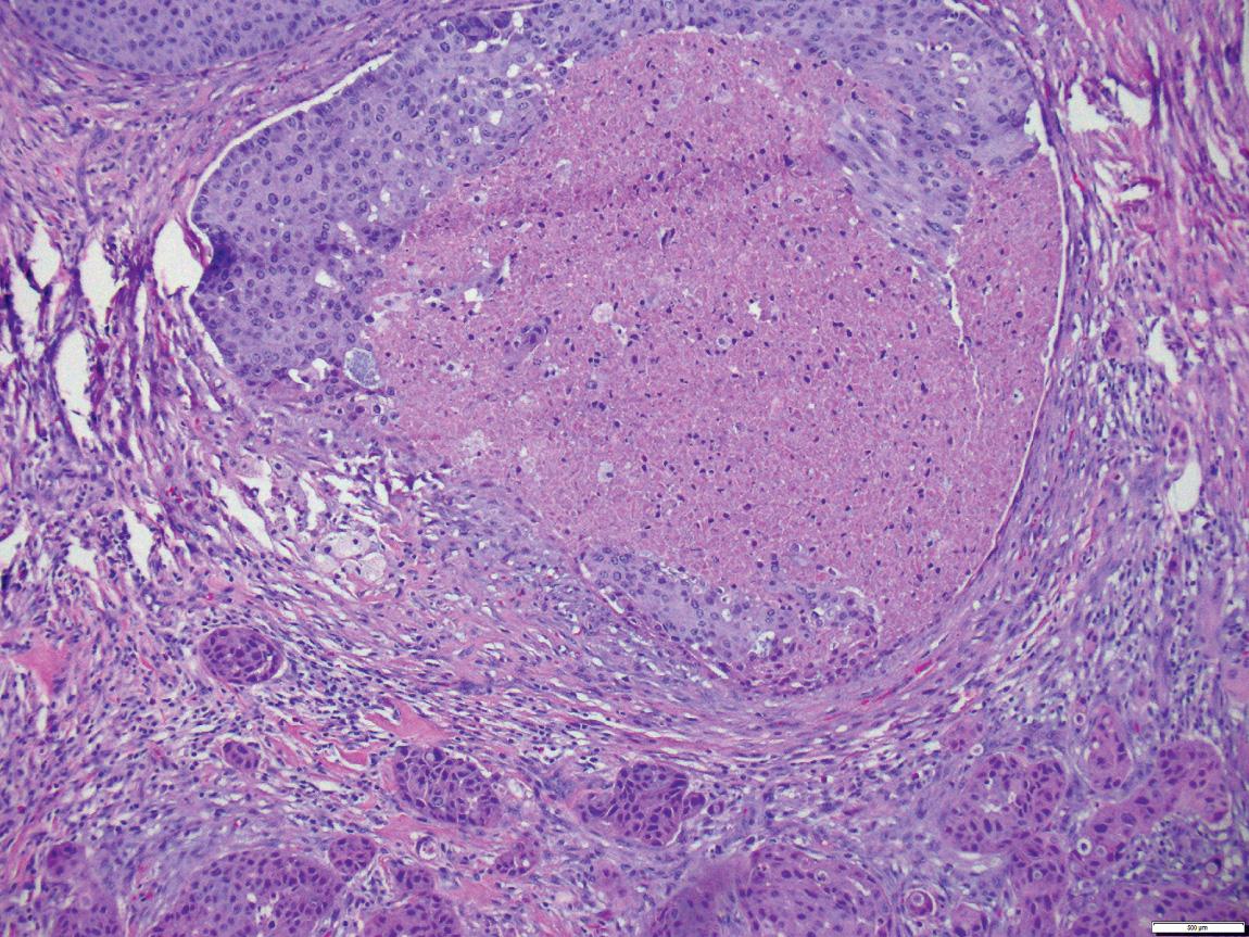 Figure 13.37, Salivary duct carcinoma.