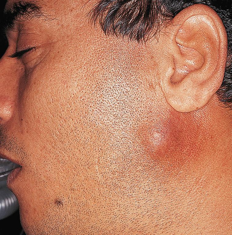 Figure 13.9, Invasion of the overlying skin is highly suggestive of a malignant tumor.