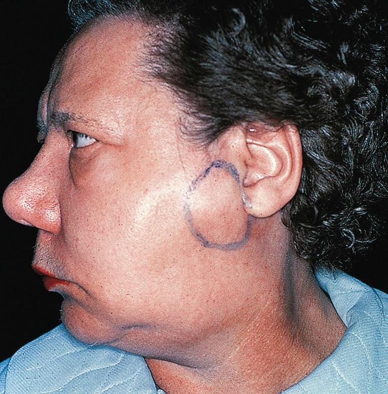 Figure 13.10, The lateral view of a patient with a carcinoma of the parotid gland.