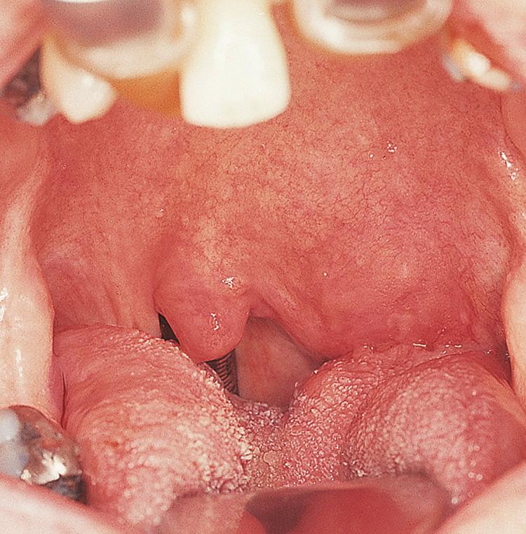 Figure 13.12, A deep lobe parotid tumor presenting as a parapharyngeal mass.