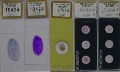 Figure 22-1, FNAB slides. Smears from a salivary gland tumor stained with May–Grünwald–Giemsa, Papanicolaou, MIB-1 and immunocytochemistry.