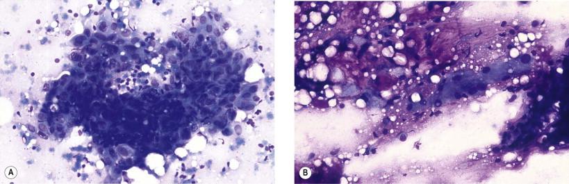 Figure 22-11, Pleomorphic adenoma. (A) Squamous cell metaplasia is occasionally found in smears from otherwise typical pleomorphic adenoma (May–Grünwald–Giemsa, ×MP). (B) Mucoepidermoid carcinoma in pleomorphic adenoma (May–Grünwald–Giemsa, ×MP).