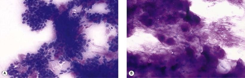 Figure 22-12, Pleomorphic adenoma. (A) Globoid structures are rare findings in otherwise typical pleomorphic adenomas (May–Grünwald–Giemsa, ×MP). (B) Some cases are dominated by mature chondroid substance (May–Grünwald–Giemsa, ×LP).