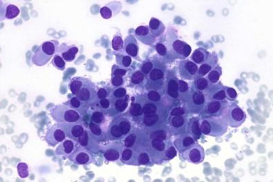 Figure 22-13, Myoepithelioma. Monomorphic plasmacytoid cells with only sparse mucoid substance (May–Grünwald–Giemsa, ×HP).