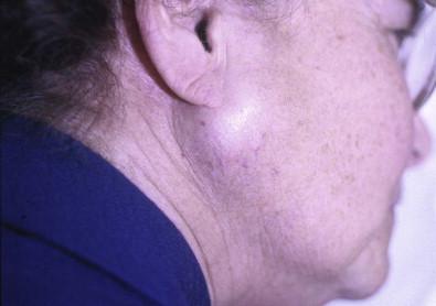 Figure 22-14, Cystadenolymphoma (Warthin's tumor). Swelling of the lower portion of the parotid gland.