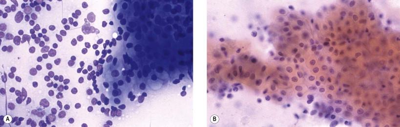 Figure 22-15, Cystadenolymphoma. Aspirate showing lymphoid cells and a flat sheet of polyhedral oncocytic cells with well-defined cellular borders in a honeycomb arrangement (A, May–Grünwald–Giemsa, ×HP; B, Papanicolaou, ×HP).