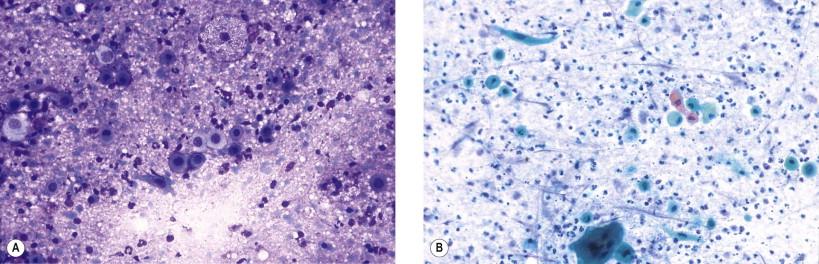 Figure 22-16, Cystadenolymphoma. Squamous cell metaplasia with distinct atypia (A, May–Grünwald–Giemsa, ×MP; B, Papanicolaou, ×MP).