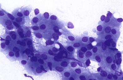 Figure 22-17, Oncocytoma. Sheets of polygonal oncocytic cells with large granular cytoplasm (May–Grünwald–Giemsa, ×HP).