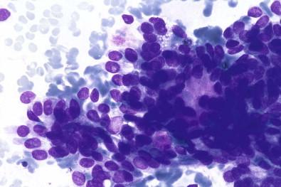 Figure 22-18, Basal cell adenoma. Irregular tumor fragments with monomorphic tumor cells mixed with some amorphous matrix material (May–Grünwald–Giemsa, ×HP).