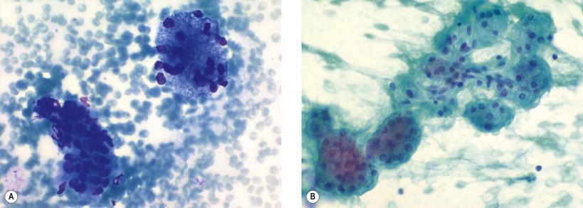 Figure 22-3, Normal salivary gland. Aspirate. (A) Cohesive ball-like formations constituted by acinar cells and a group of ductal cells (May–Grünwald–Giemsa, ×HP). (B) Groups of acinar cells with abundant granular and well-demarcated cytoplasm. The nuclei are round and centrally located (Papanicolaou, ×HP).