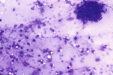 Figure 22-4, Acute sialoadenitis. Clusters of epithelial cells admixed with cellular debris and neutrophils (May–Grünwald–Giemsa, ×MP).