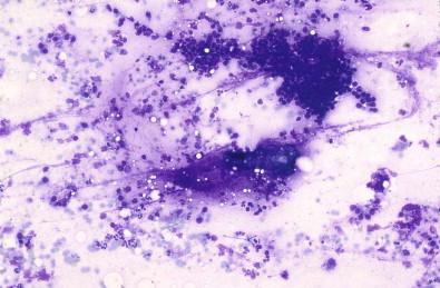 Figure 22-5, Obstructive chronic sialoadenitis showing mucus, macrophages, and clusters of epithelial cells (May–Grünwald–Giemsa, ×MP).