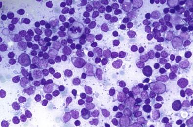 Figure 22-7, Lymphoepithelial lesion. Small lymphocytes mixed with follicle center cells (May–Grünwald–Giemsa, ×HP).