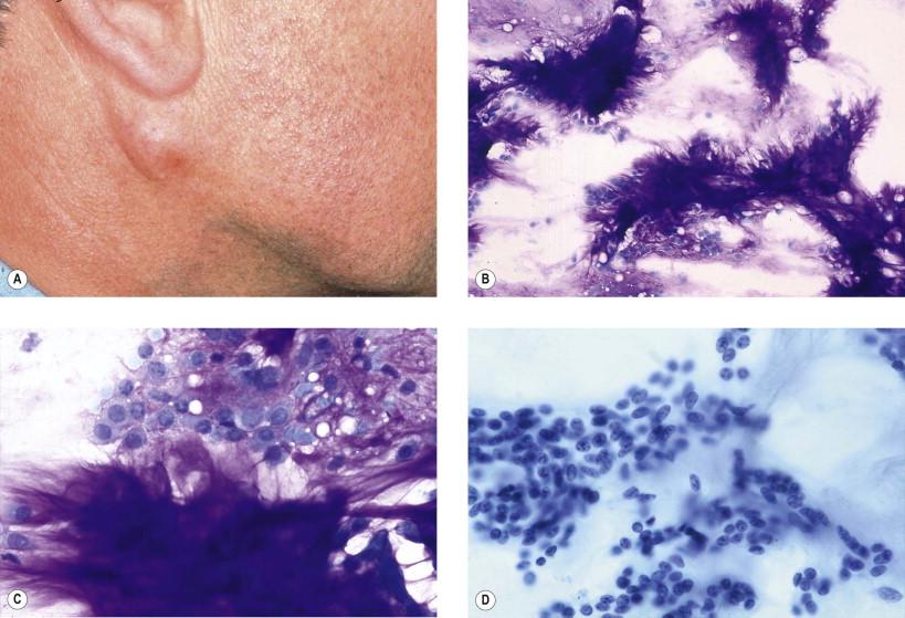 Figure 22-8, Pleomorphic adenoma. (A) Clinical presentation. (B) Aspirate showing the dense, fibrillar chondromyxoid stroma and monomorphous myoepithelial cells (May–Grünwald–Giemsa, ×LP). (C) The fibrillar myxoid stroma is easily identified in May–Grünwald–Giemsa stain (pink) (×HP). (D) Poorly visible stroma in Papanicolaou (×HP).