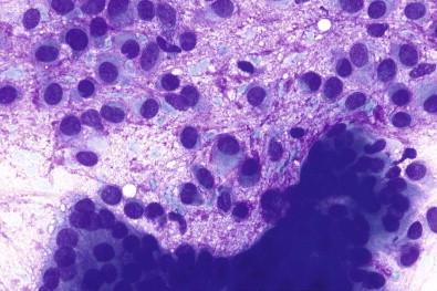 Figure 22-9, Pleomorphic adenoma. Myoepithelial cells with round or oval nuclei with evenly distributed chromatin and tiny nucleoli. Epithelial cells are sometimes seen mixed with typical myoepithelial cells (May–Grünwald–Giemsa, ×HP).