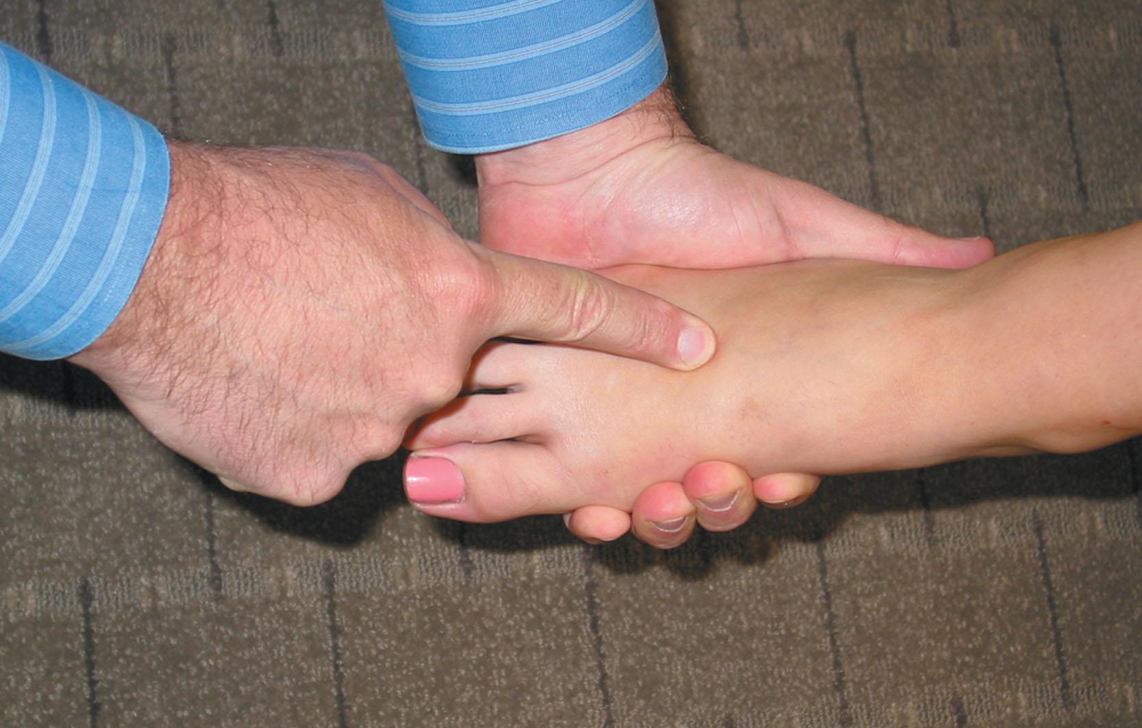 Fig. 11.1, Eliciting Mulder sign for Morton neuroma. Mulder sign is elicited by firmly squeezing the metatarsal heads together with one hand while placing firm pressure on the interdigital space with the other.