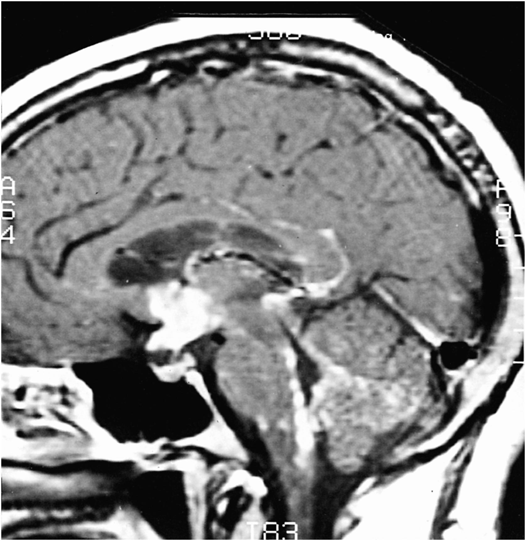 Figure 49-8, Cranial MRI, sagittal section, T1-weighted image with gadolinium, showing hypothalamic and pituitary involvement by sarcoidosis.