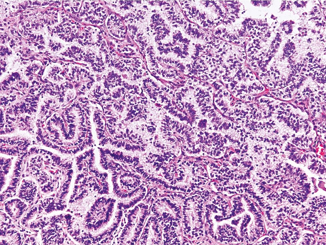 Figure 15.11, Fetal-type adenocarcinoma of the lung, composed of malignant glandular elements resembling the developing fetal lung. Although these malignant glandular elements impart an appearance reminiscent of pulmonary blastoma, fetal-type adenocarcinoma lacks a malignant stromal component.