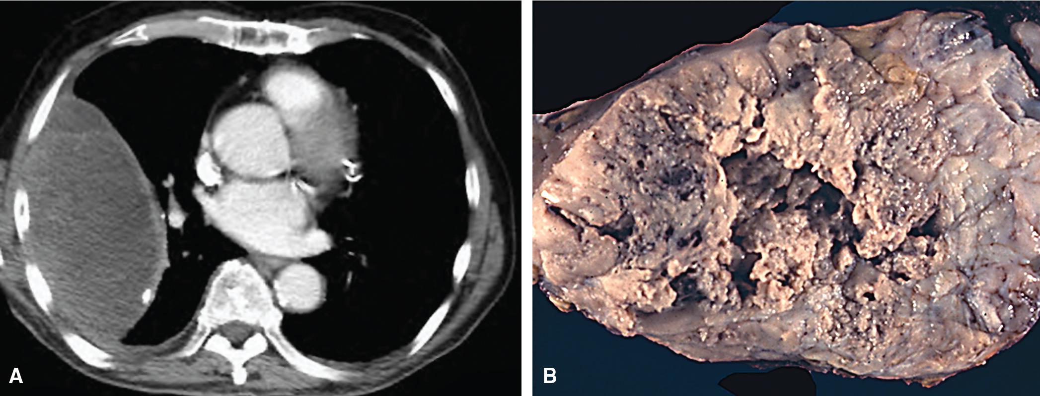 Figure 15.12, (A) Computed tomography image and (B) gross photograph of localized sarcomatoid mesothelioma.