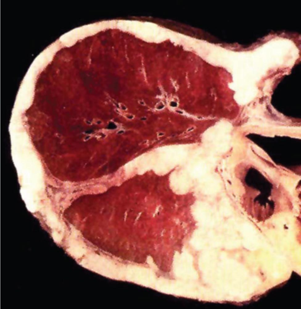 Figure 15.13, An extrapleural pneumonectomy specimen in this case of mesothelioma demonstrates circumferential encasement of the lung by tumor tissue and extension into the interlobar septa.