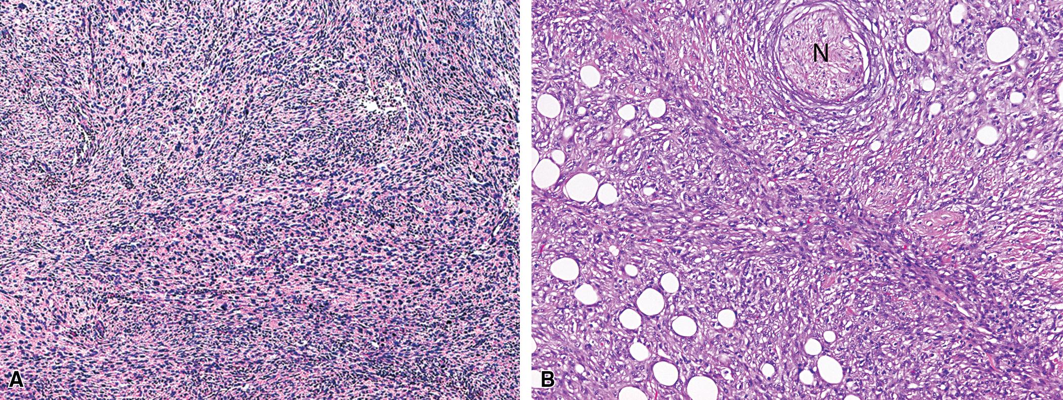 Figure 15.14, (A and B) Microscopic images of sarcomatoid mesothelioma, showing a disorganized proliferation of highly atypical spindle cells, surrounding a nerve (N) . Metastatic or pleurotropic sarcomatoid carcinoma and true sarcomas of the pleura are differential diagnostic alternatives.