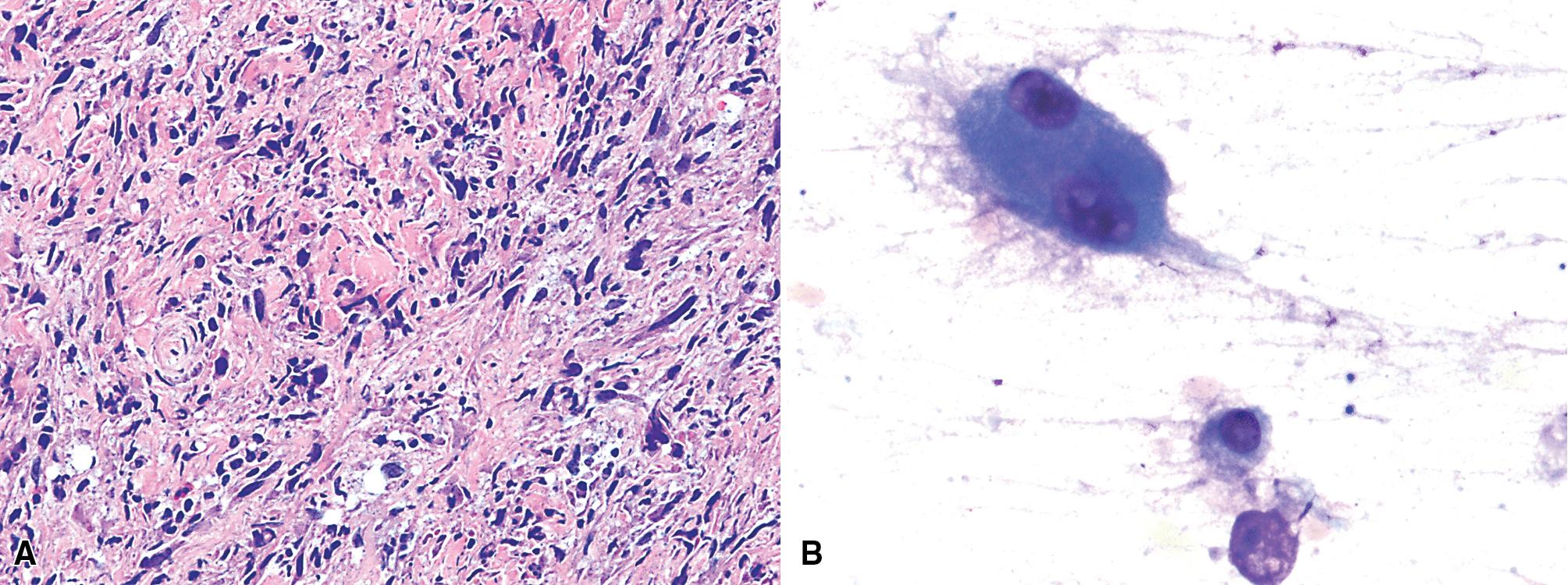 Figure 15.15, (A) Another example of sarcomatoid mesothelioma with more anaplastic cytology, simulating the appearance of pleomorphic sarcomas. This attribute is also visible in a fine-needle aspiration smear specimen (B).