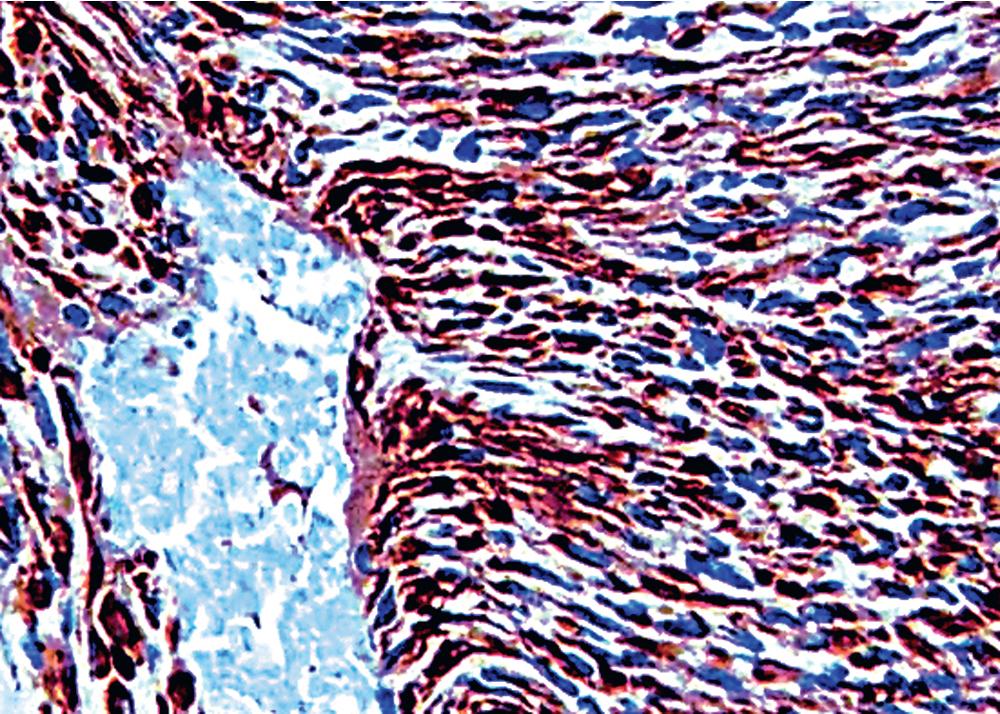 Figure 15.17, Diffuse immunoreactivity for D2-40 is seen in this sarcomatoid mesothelioma.