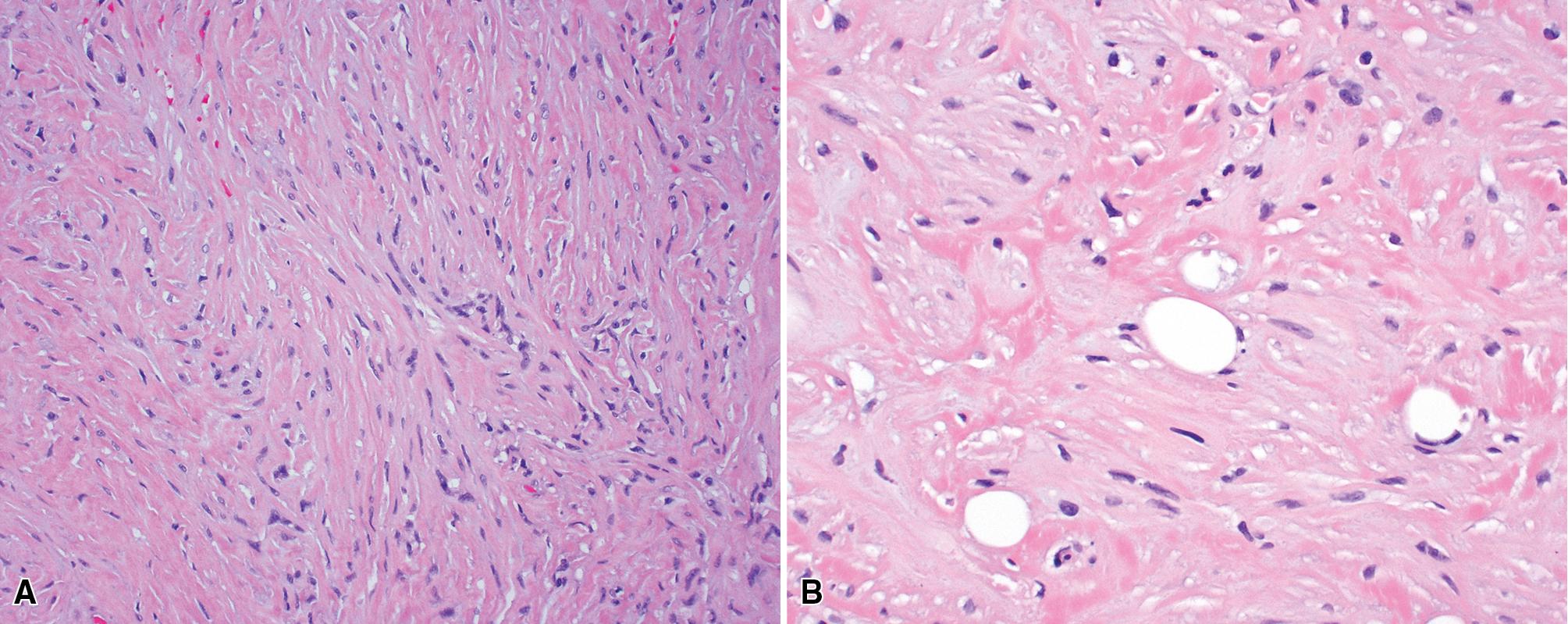 Figure 15.18, (A and B) Desmoplastic sarcomatoid mesothelioma composed of minimally atypical spindle cells set in a densely hyalinized collagenous stroma. The distinction from fibrous pleurisy is often difficult.