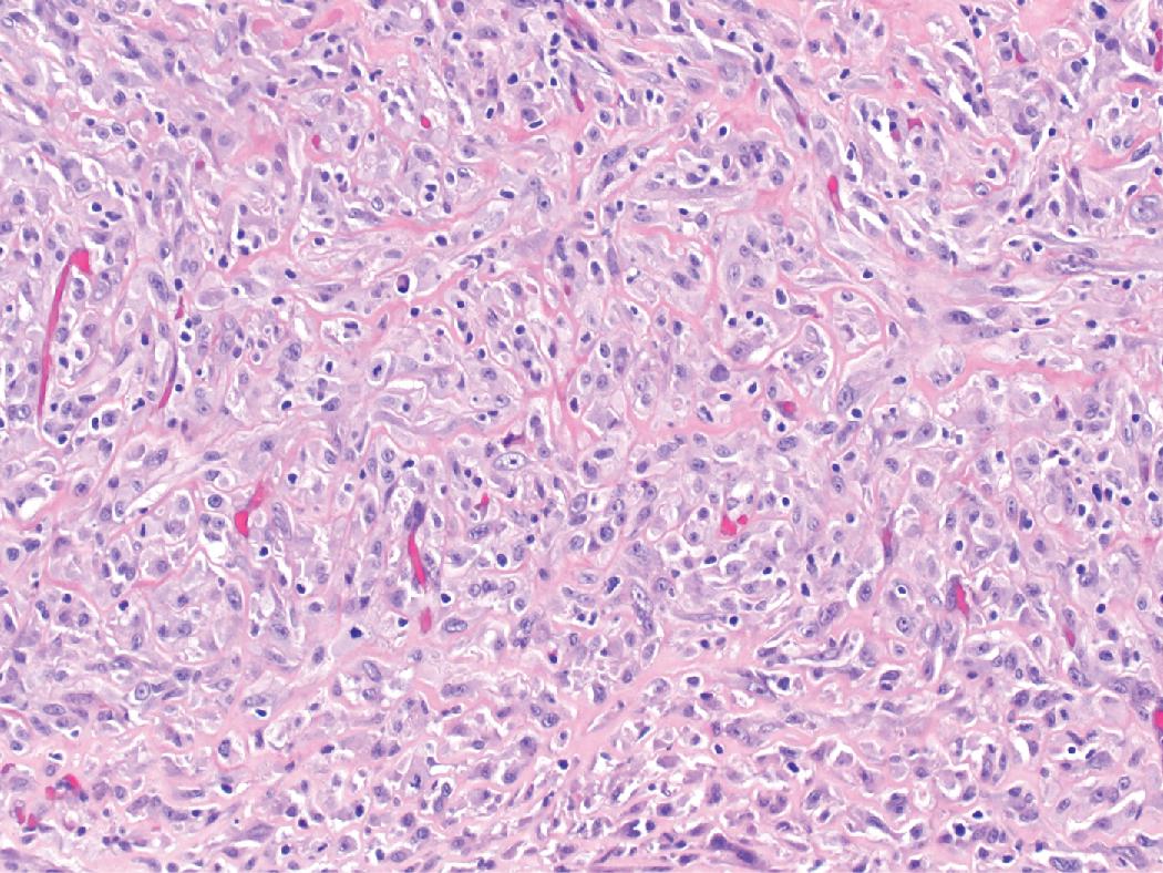 Figure 15.20, The transitional variant of mesothelioma shows tumor cells with an appearance intermediate between epithelioid and spindled cytology. This distinctive variant is aggressive and behaves in a fashion similar to sarcomatoid mesothelioma and is now formally recognized by the WHO as a subtype of sarcomatoid mesothelioma.