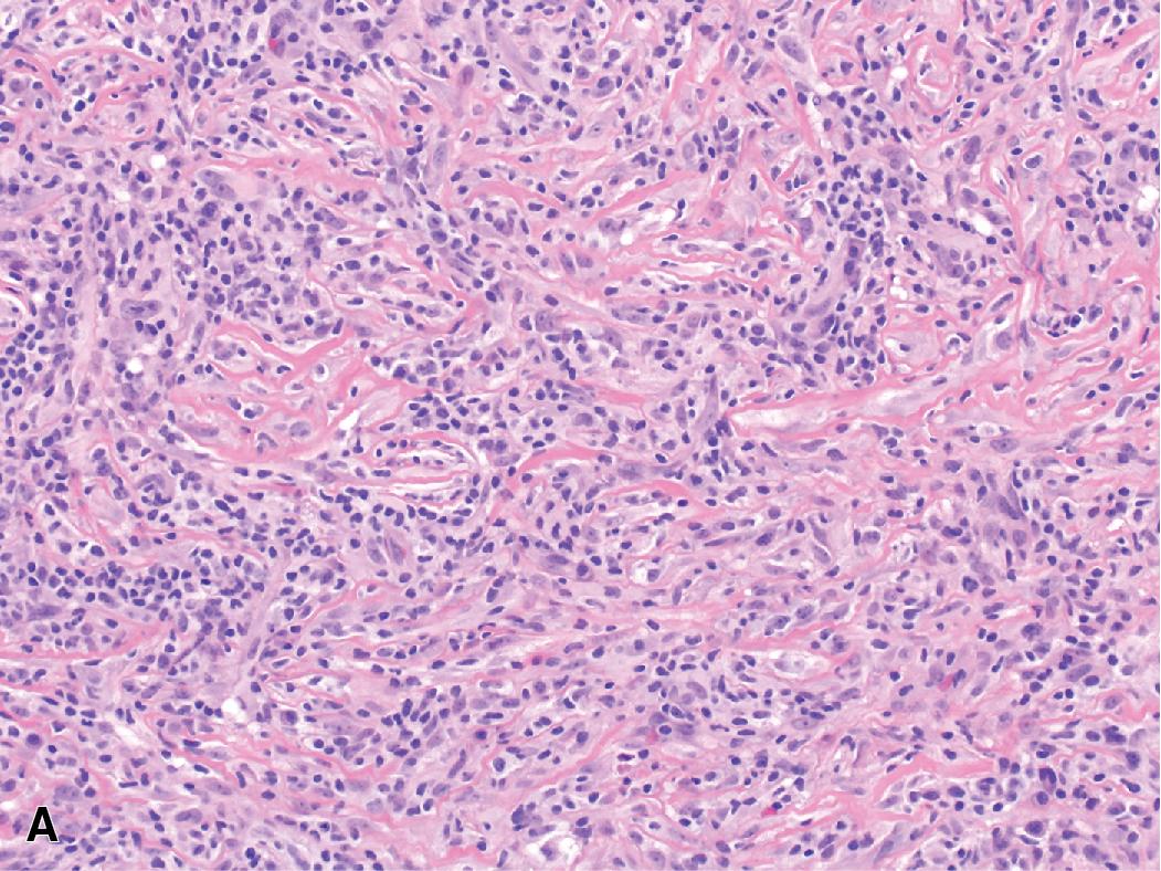 Figure 15.21, As its name implies, the lymphohistiocytoid variant of mesothelioma shows (A) a dense inflammatory infiltrate composed predominantly of lymphocytes that partially obscures the malignant mesothelial cells in the background. Adding to the challenge, the neoplastic cells show a histiocytoid appearance, possibly causing confusion with a benign inflammatory process. (B) Immunohistochemistry for pankeratin facilitates recognition of the tumor and avoidance of this potential diagnostic pitfall.