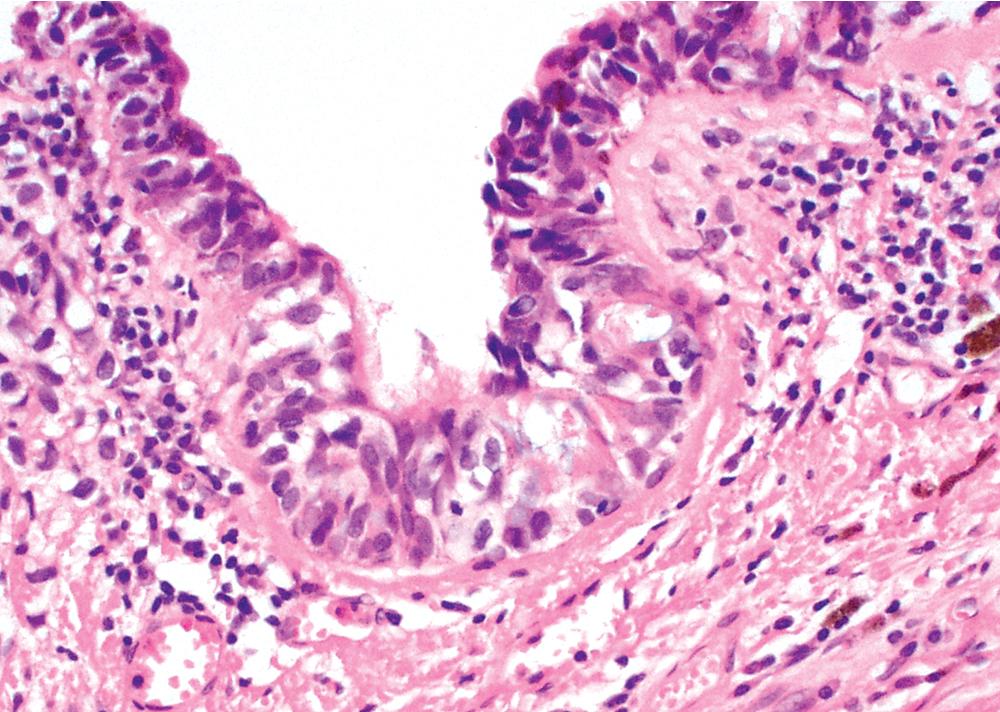 Figure 15.22, Putative melanoma in situ within the bronchial mucosa, with tumor cells scattered throughout the epithelium randomly. Although this finding has been used to support the notion that melanoma can rarely arise as a primary tumor in the lung, others have contended that this simply represents a form of pagetoid spread or colonization of the mucosa. Ultraviolet radiation mutational signatures reported in cases of presumed primary pulmonary melanoma suggest that virtually all melanomas in the lung represent metastases from occult cutaneous sites.