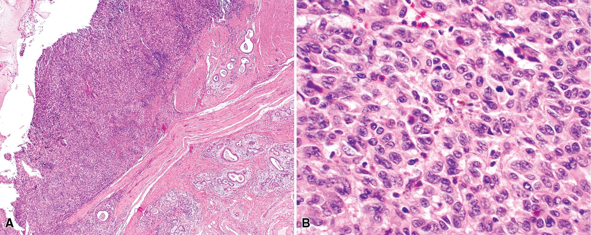 Figure 15.23, (A and B) Putative primary malignant melanoma of the lung represented by an amelanotic proliferation of pleomorphic tumor cells within a bronchus. Immunohistologic studies were necessary to support the presence of melanocytic differentiation in this case.