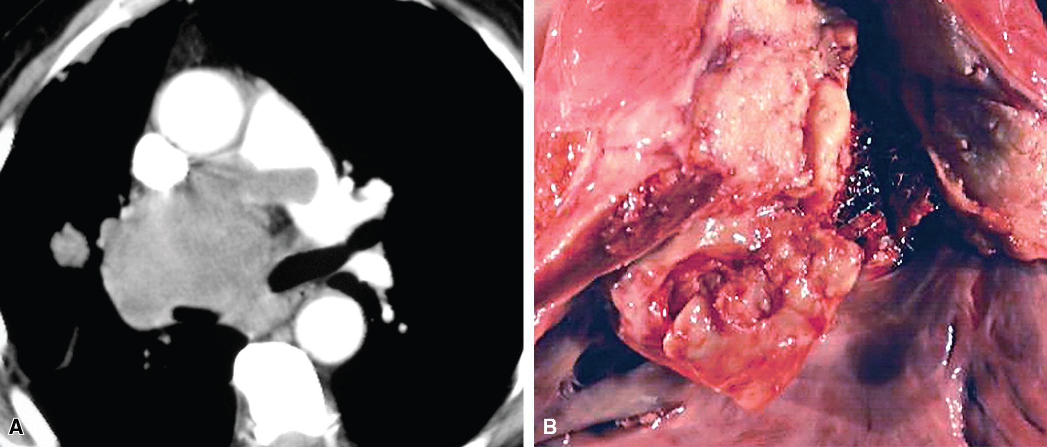 Figure 15.24, (A) Computed tomographic image showing a mass within the pulmonary trunk representing intimal sarcoma. (B) Another intimal sarcoma in the pulmonary trunk as seen at autopsy.