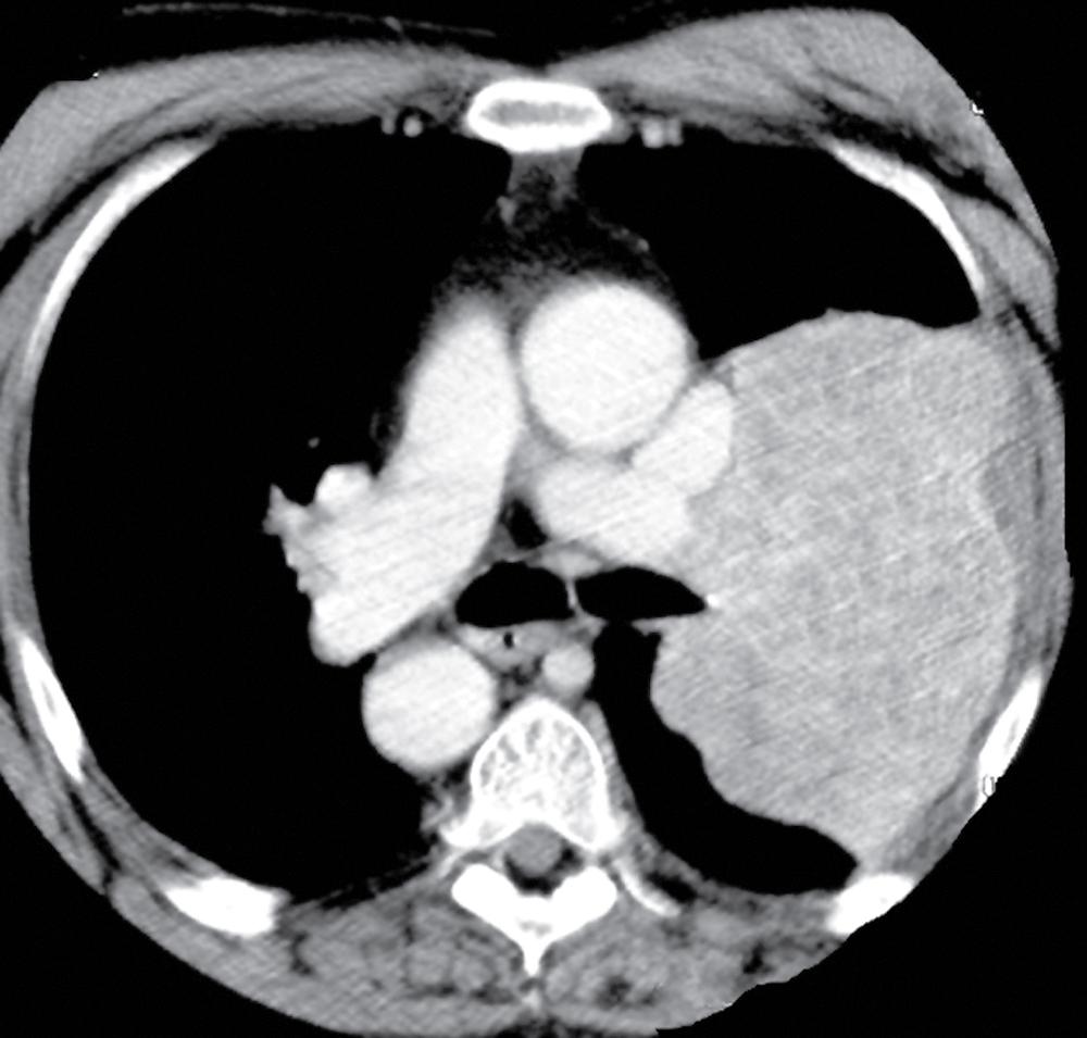 Figure 15.26, Computed tomogram of the thorax showing primary leiomyosarcoma of the left lung.