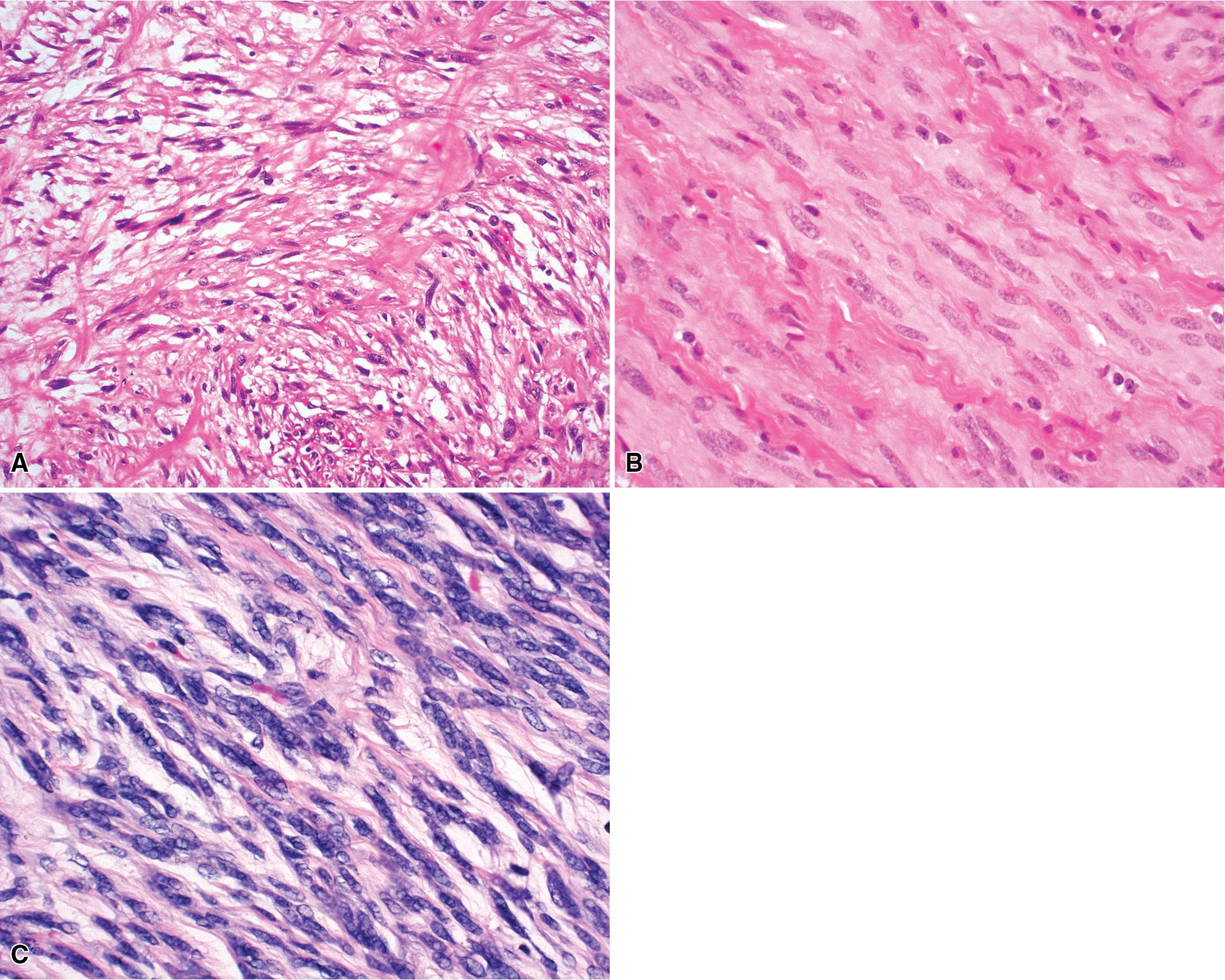 Figure 15.27, (A–C) Leiomyosarcoma of the lung shows fascicular growth of atypical spindle cells with blunt-ended nuclei, fibrillary cytoplasm, and dense cellularity.