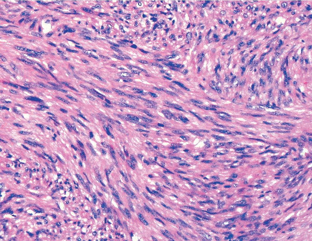 Figure 15.28, Malignant cytomorphologic features are well seen in this primary pulmonary leiomyosarcoma.