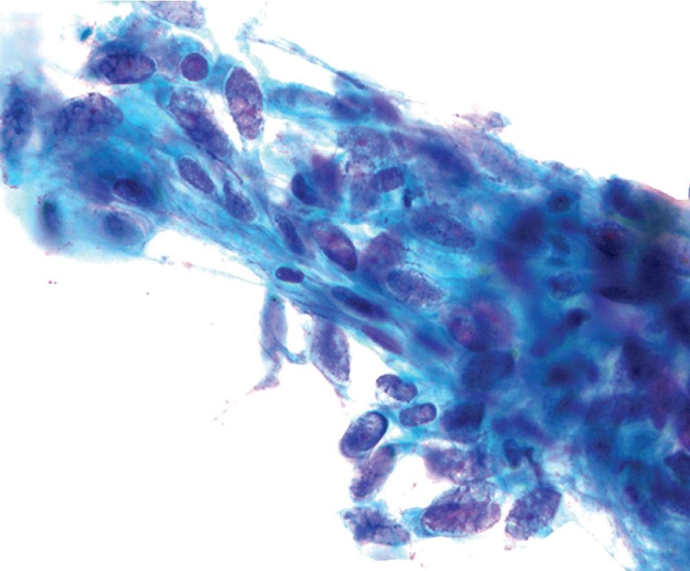 Figure 15.29, Fine-needle aspiration smear of primary pulmonary leiomyosarcoma, showing loosely cohesive tumor cells with blunt-ended fusiform nuclei.