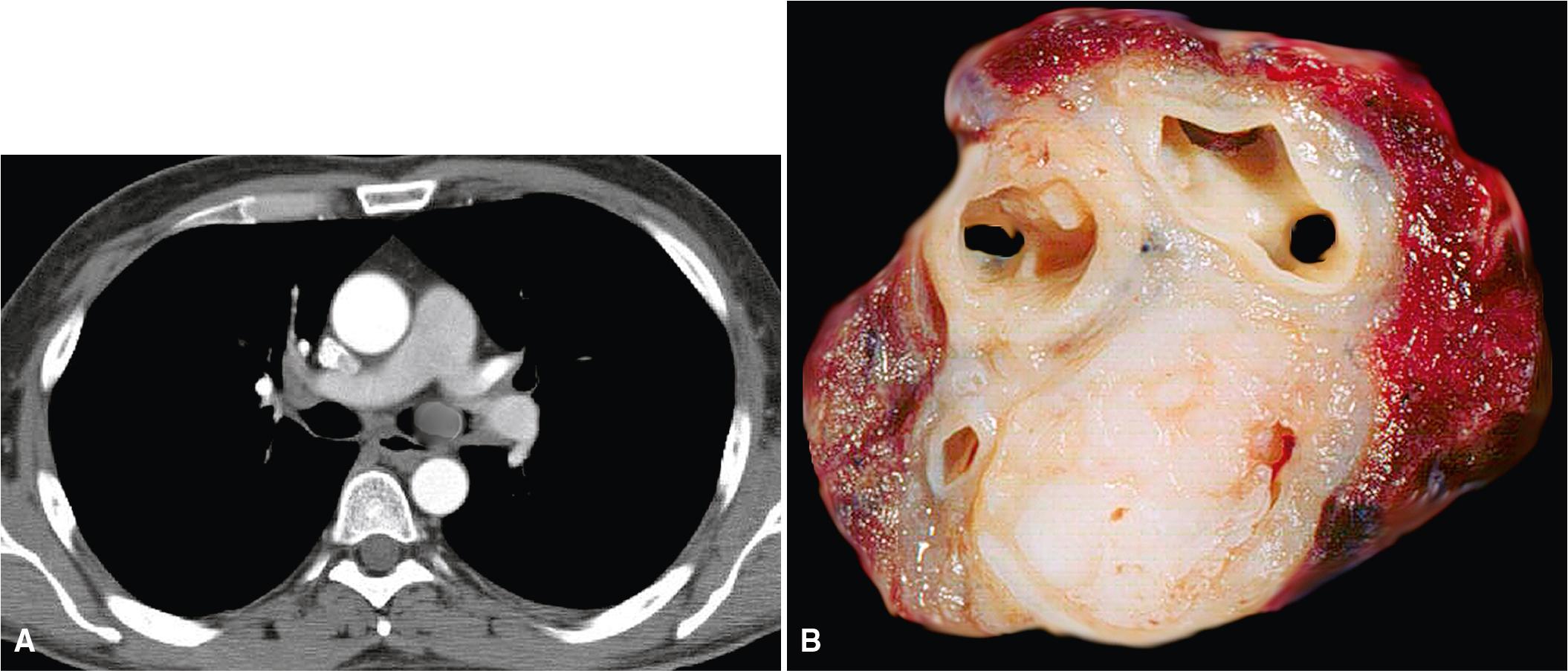 Figure 15.3, (A) Computed-tomographic image showing an endobronchial mass in the left mainstem bronchus. (B) Resection of the lung demonstrated an endoluminal neoplasm that proved to be a sarcomatoid carcinoma.