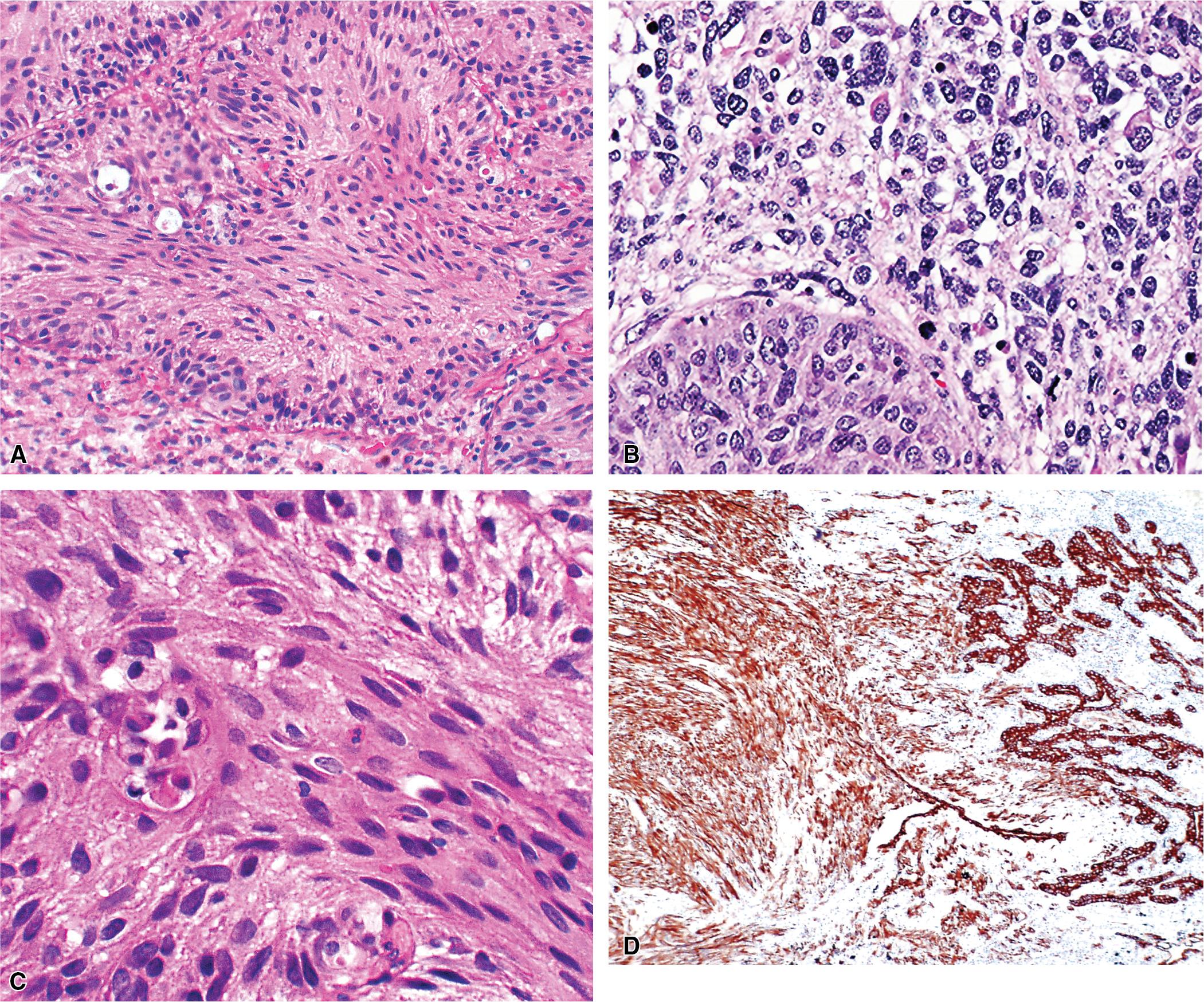 Figure 15.4, (A–C) Sarcomatoid carcinoma of the lung, showing overtly epithelial elements with an abrupt transition to malignant spindled or sarcoma-like elements (i.e., the “pleomorphic carcinoma” variant of sarcomatoid carcinoma). (D) Immunohistochemistry for keratin demonstrates reactivity in both neoplastic components.
