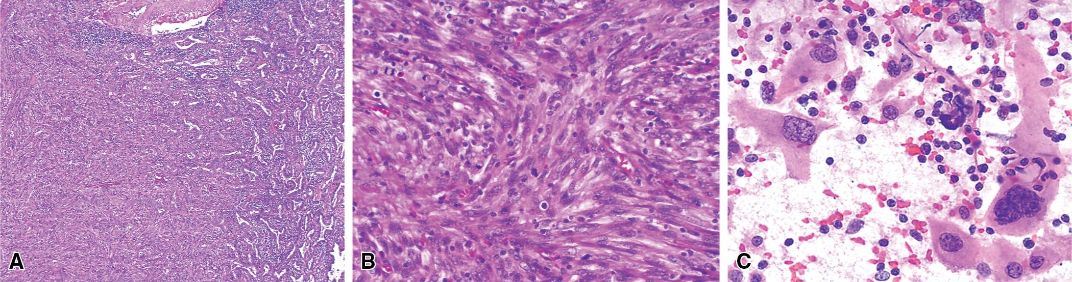 Figure 15.5, (A and B) Storiform growth of neoplastic fusiform and pleomorphic cells in sarcomatoid carcinoma of the lung, simulating undifferentiated pleomorphic sarcoma. (C) Fine-needle aspiration of sarcomatoid carcinoma, showing discohesive and pleomorphic malignant cells like those seen in true sarcomas.