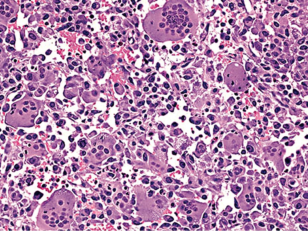 Figure 15.6, Osteoclast-like giant cells are interspersed with the malignant spindle cells of this sarcomatoid carcinoma of the lung.
