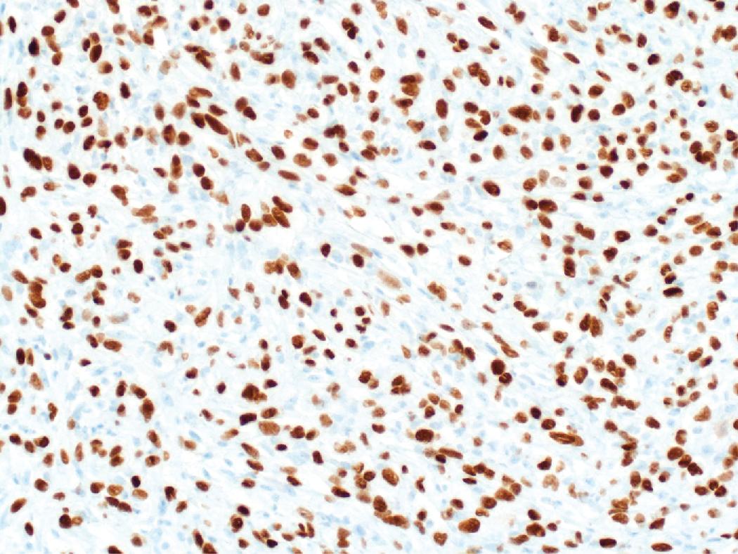 Figure 15.7, Markers typically associated with pulmonary nonsmall cell carcinomas are sometimes expressed in sarcomatoid carcinoma, as in this case showing strong nuclear expression of TTF-1, enabling distinction from other sarcomatoid malignancies in the differential diagnosis.