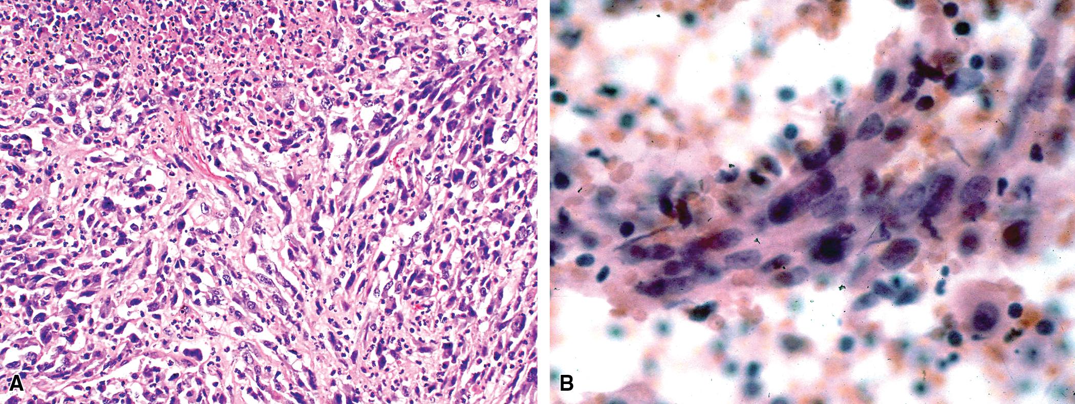 Figure 15.8, (A) Sarcomatoid carcinoma of the lung composed purely of malignant spindle cells (i.e., the “spindle cell carcinoma” variant of sarcomatoid carcinoma). (B) Fine-needle aspiration specimens from this case demonstrate loosely cohesive aggregates of malignant spindle cells.