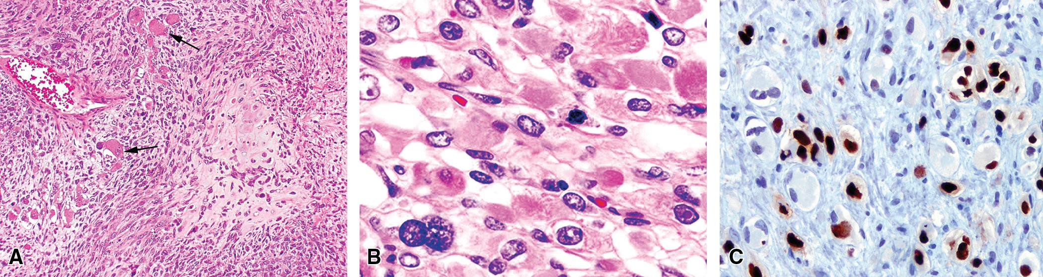 Figure 15.9, (A) Sarcomatoid carcinoma of the lung with heterologous rhabdomyosarcomatous elements (representing an example of the “carcinosarcoma” variant of sarcomatoid carcinoma), showing epithelial elements juxtaposed to frank rhabdomyosarcoma-like elements (arrows) . (B) Cytoplasmic eosinophilia is present in the rhabdomyosarcoma-like cells that also show (C) immunoreactivity for myogenin.