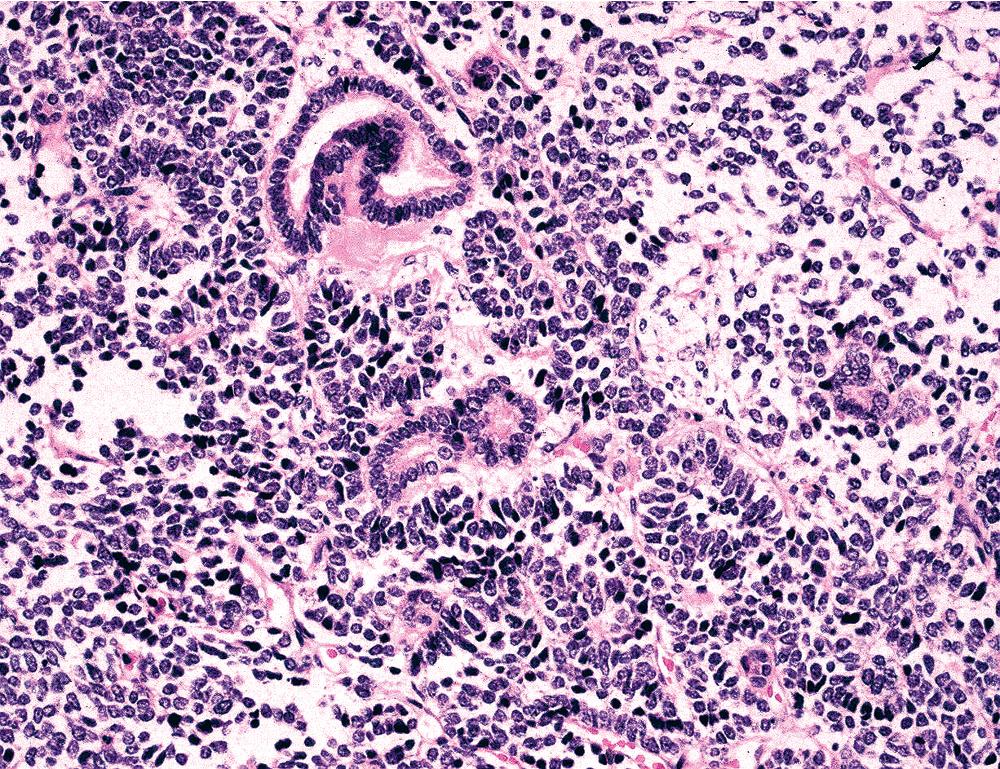 Figure 15.10, Pulmonary blastoma showing an admixture of fetal glands and undifferentiated blastema-like spindle cell elements. This tumor is a distinctive morphologic form of sarcomatoid carcinoma, and it occurs preferentially in adults rather than children.