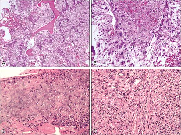 Figure 89.1, (A) Low-power photomicrograph of an osteoblastic osteosarcoma shows residual trabeculae of medullary bone surrounded by a cellular tumor. This pattern of invasion of bone indicates a malignant tumor even at this power. One can see the lacy, woven tumor bone formation by the sarcoma in contrast to the partially resorbed preexisting lamellar bone trabeculae. (B) High-power photomicrograph of an osteosarcoma shows bizarre, pleomorphic tumor cells that vary in size and shape and have large, aberrant nuclei. Some cells show abnormal mitoses, and intermixed is scant woven tumor bone. (C) Field shows a chondroblastic osteosarcoma. The malignant cartilage formation is well demonstrated. One would have to search other areas of the tumor to document bone formation that was present in this case. (D) Field shows a high-grade spindle cell sarcoma area that is characteristic of a fibroblastic osteosarcoma.