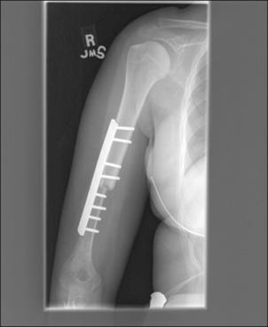 E-Figure 89.3, Osteoarticular allograft for proximal humerus osteosarcoma resection.