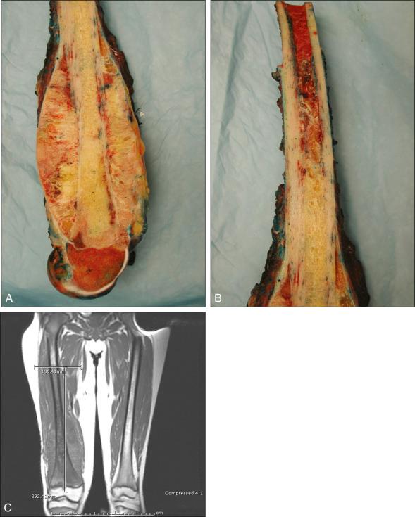 Figure 89.2, (A) Gross photograph of an osteosarcoma of the distal femur. The medullary cavity is filled with tumor, which has replaced the normal marrow contents. The tumor has penetrated and incompletely destroyed the cortex and penetrated through the growth plate distally. The Codman triangle, which is an incomplete host periosteal response, is well demonstrated. Histologically, this would show woven periosteal bone. One can also appreciate how this tumor could enter the joint under the synovium, anteriorly in this case. (B) A section from higher in the femur shows where the medullary extent of the tumor ends rather abruptly. There is a margin of normal marrow proximal to the marrow extent. (C) Coronal T1-weighted image of this case nicely shows the extent of the tumor in the medullary cavity and the penetration of the growth plate. It corresponds to the preceding findings seen on the gross specimen.